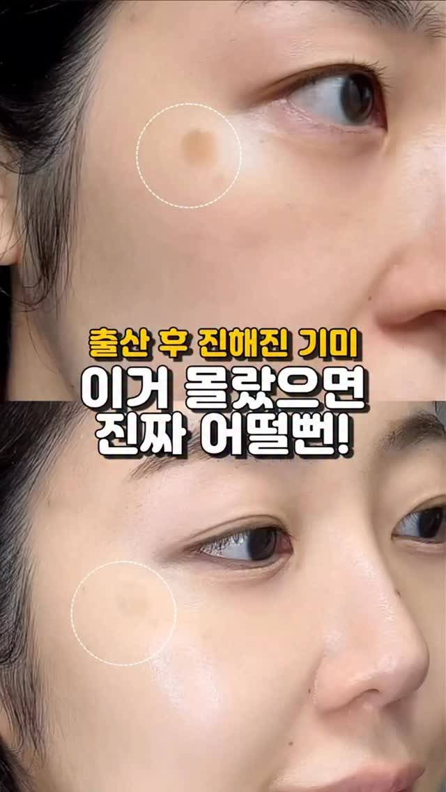 hailey_world__ 게시물 이미지: #광고 | 출산 후 기미, 몰랐으면 진짜 어쩔뻔?🫨

출산 후 생긴 기미·잡티…...