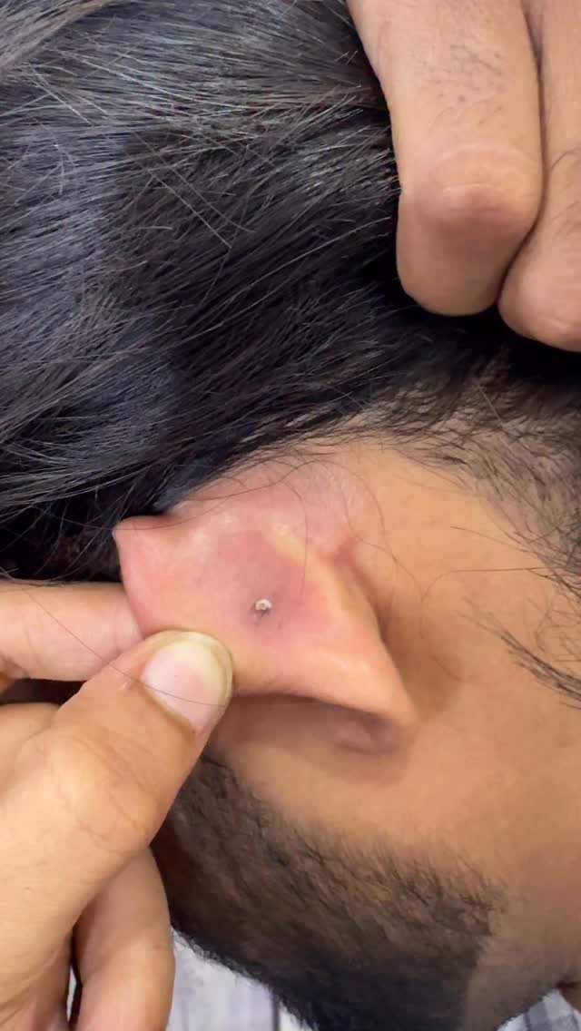 hairstylergulbahar 게시물 이미지: Ear👂🏼blackheads 😱 
.
Follow:-...