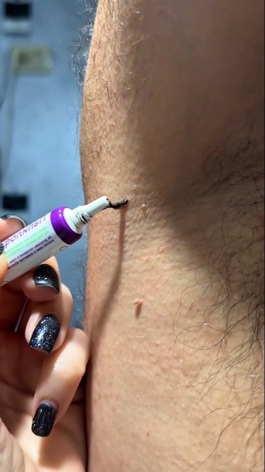 hairtips.diy 게시물 이미지: @glow.tulip Say goodbye to stubborn warts —...