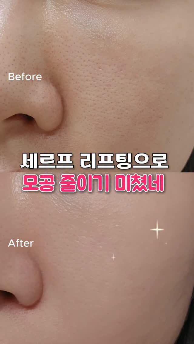 hamnihouse 게시물 이미지: 여름이라 모공 늘어짐 장난 아닌 요즘..
리프티으로 모공탄력 꽉 잡아줬어요~!...