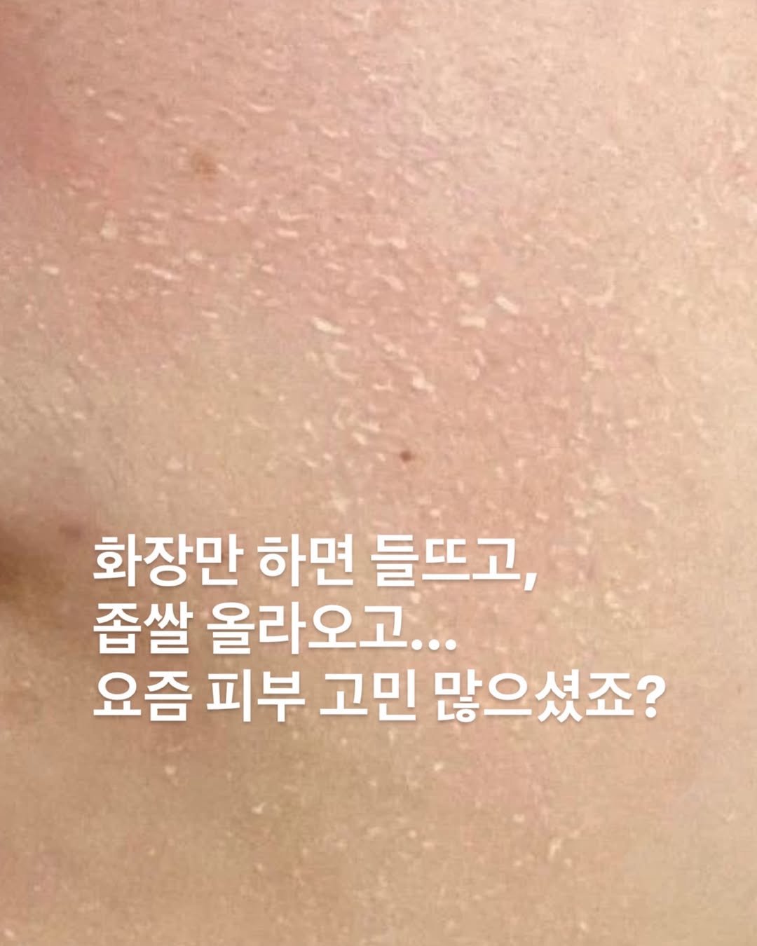 Photo by 손하윤 (바비윤)🐰 | 피부과9년차가 알려주는 피부관리 다이어트 뷰티 꿀팁 on December 04, 2025. May be an image of ointment and text that says '화장만 하면 들뜨고, 좁쌀 올라오고... 요즘 피부 고민 많으셨죠?'.