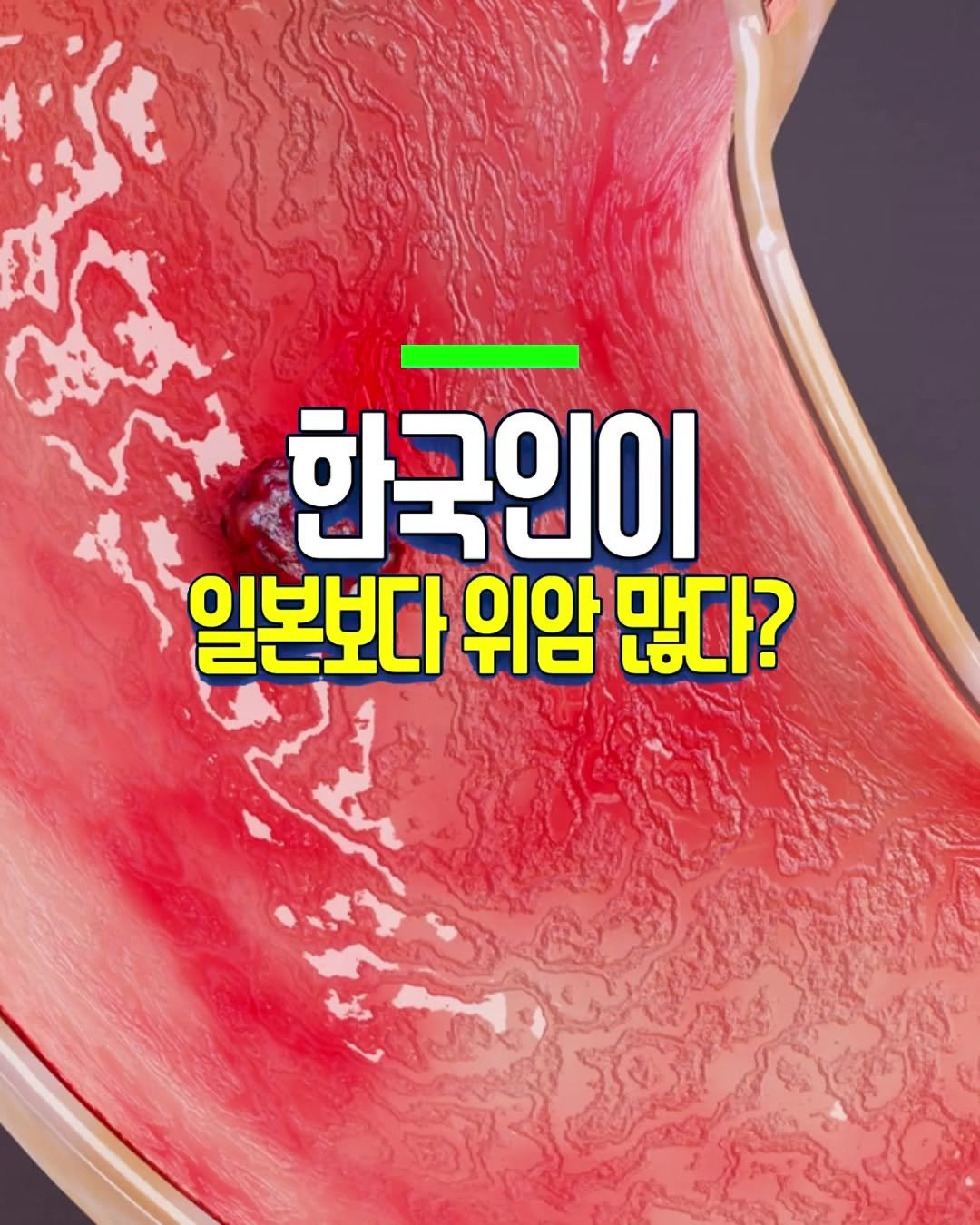 Photo by 건강천재 on April 26, 2026. May be an image of text that says '한국인이 일본보다 위암 많다?'.