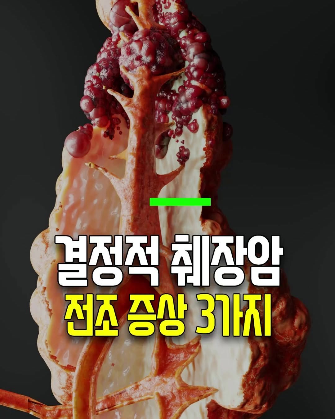 health_genius_ 게시물 이미지: 결정적 췌장암 전조증상 3가지

암중에 제일 무서운 암 하면 빠지지 않는 것이...