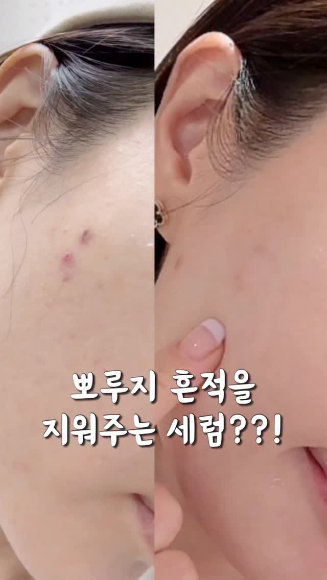 health_reemom 게시물 이미지: #광고
환절기만 되면 잡티, 뾰루지 자국 때문에
거울 볼 때마다 속상하셨죠?...