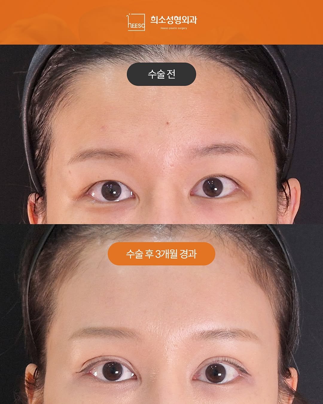 heeso_ps 게시물 이미지: 📸 이마거상 + 재수술 매몰 + 윗트임 Before & After
2025. 12....