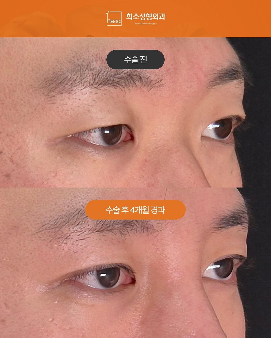 heeso_ps 게시물 이미지: 📸 남자 눈수술 Before & After
2025. 12. 30ㅣ2026. 04....