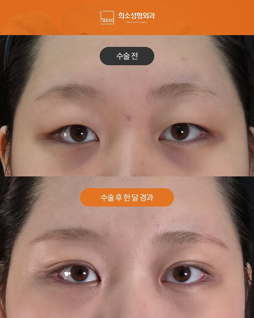 Photo by 희소성형외과 | 대전성형외과 | 임정수 대표원장🥼 in 희소성형외과. May be an image of text that says '희소성형외과 hEESO FER 1 plana: ระแ 수술전 수술후한달경과 한 달 경과 수술 후'.