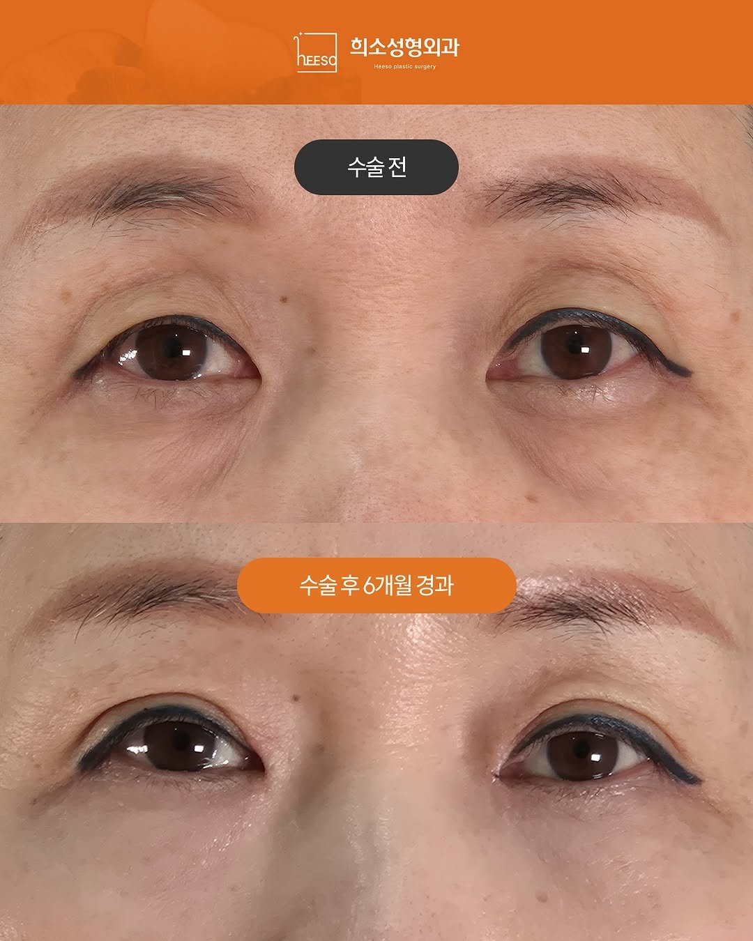 Photo by 희소성형외과 | 대전성형외과 | 임정수 대표원장🥼 in 희소성형외과. May be an image of one or more people, eyeliner and text.