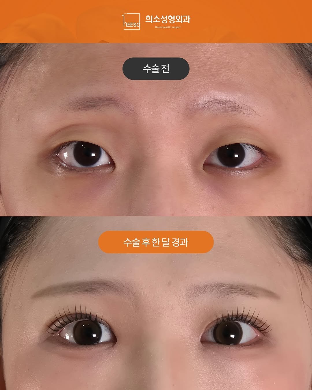 Photo by 희소성형외과 | 대전성형외과 | 임정수 대표원장🥼 in 희소성형외과. May be an image of text that says 'LEESO 희소성형외과 E a: ระแ 수술전 수술후 수술 후한 수술후한달경과 달 경과'.