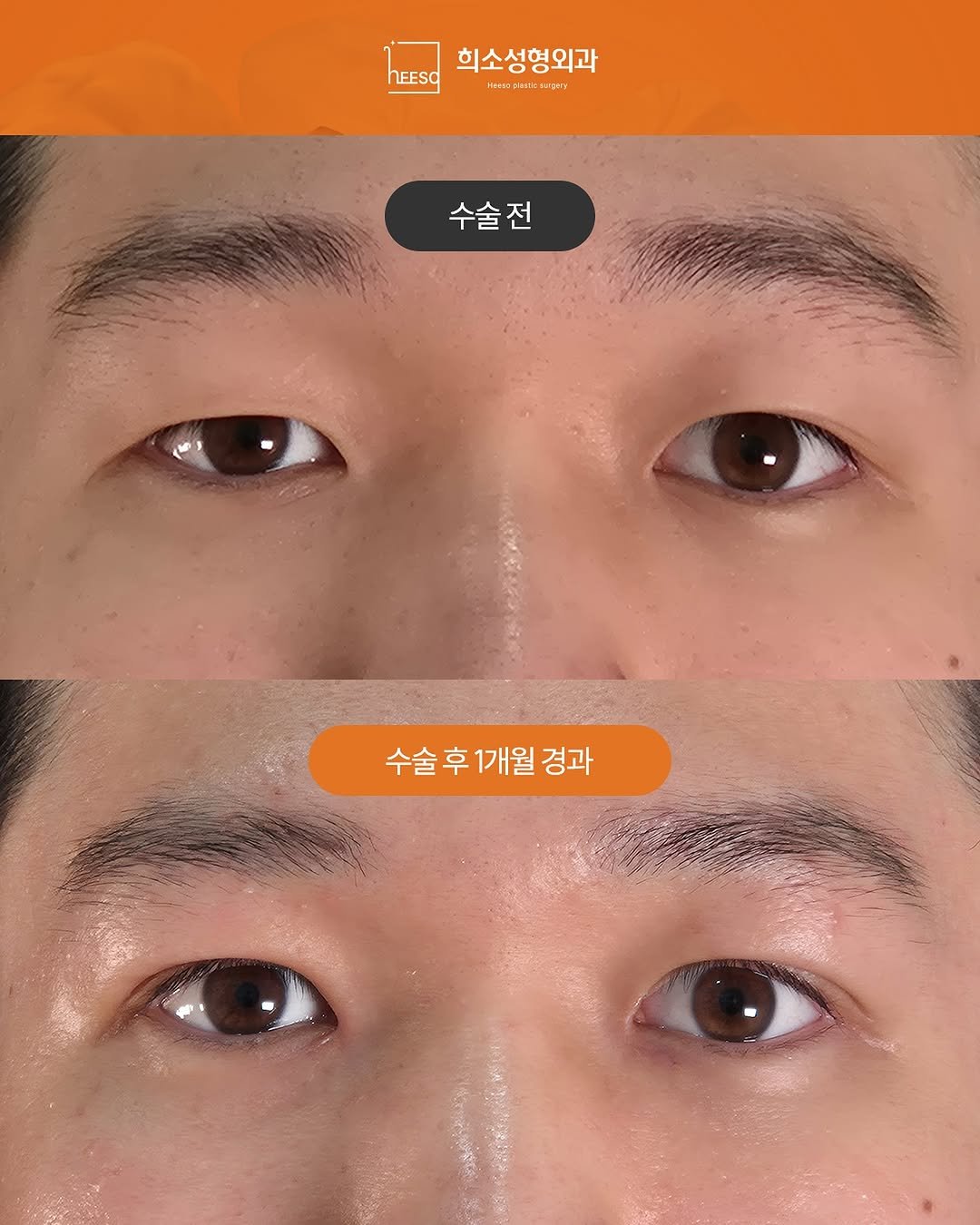 heeso_ps 게시물 이미지: 📸 남자 눈성형 Before & After
2026. 03. 05ㅣ2026. 04....