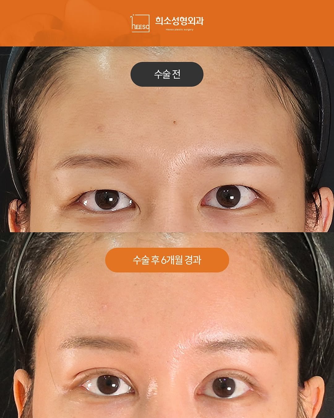 Photo by 희소성형외과 | 대전성형외과 | 임정수 대표원장🥼 in 희소성형외과. May be an image of one or more people and text.