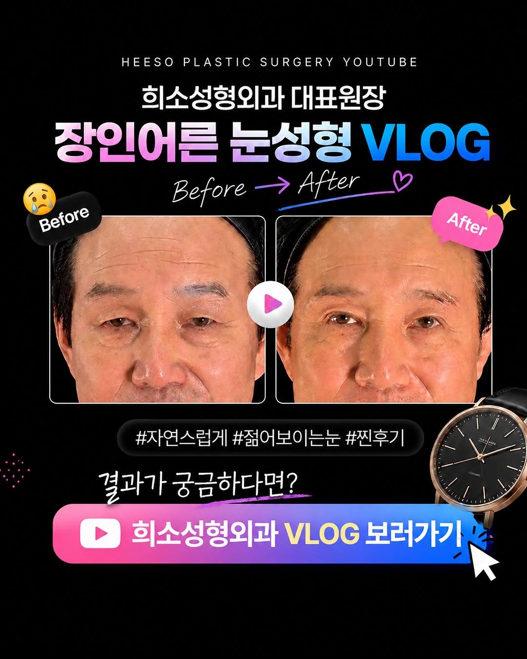 heeso_ps 게시물 이미지: 장인어른 눈성형 VLOG 공개 🎥💙

수술 전부터 회복 과정,
그리고 자연스러운...