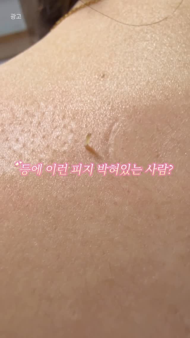hi._.jjuya 게시물 이미지: 등드름 있는 사람들 대부분 공통점이 있더라구요.
👉 등 모공 안에 피지가 계속 쌓여...