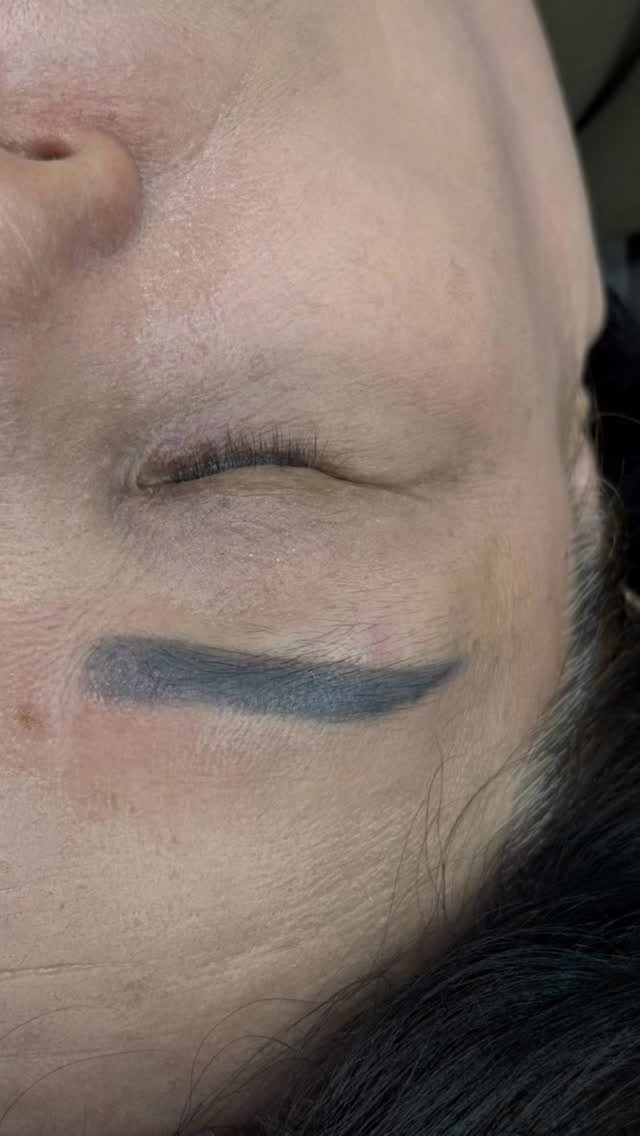 hi_green.beauty 게시물 이미지: 푸른잔흔때문에 많이 힘들어하셨던 고객님😭
피부가 얇고 약해 최대한 조심히...