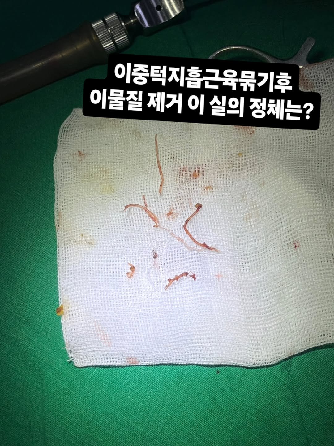 Photo by 허우진 on April 23, 2026. May be an image of text that says '이중택지흡근육류기후 이물질 제거 이 실의 정체는? ۰٠ く'.