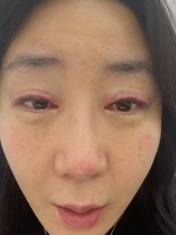 huranna 게시물 이미지: 와 20년만에 아이라인 문신 지웠어😭속 시원하다!!!!!!!!
뒷장은 지우기...