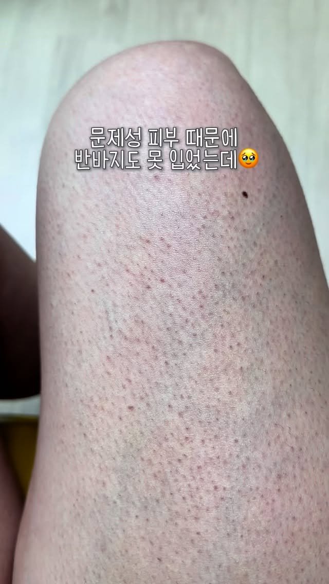 huranna 게시물 이미지: OPEN)모공이 막혀서 오톨도톨해진 피부를 이 로션이 매끈하게...