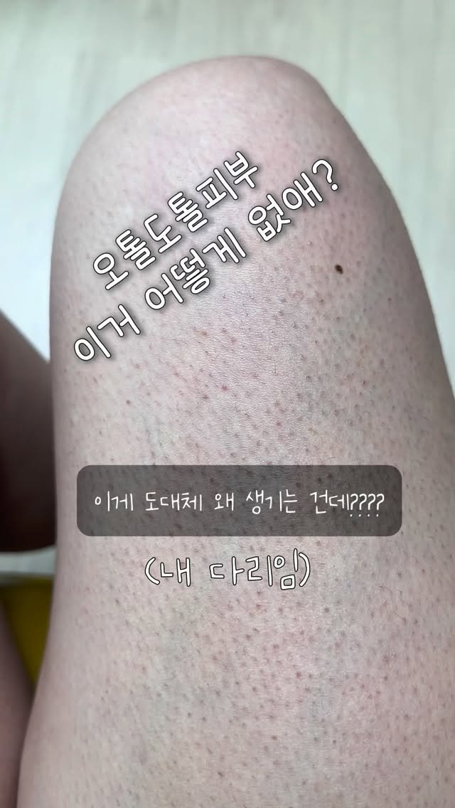 huranna 게시물 이미지: 오톨도톨한 허벅지, 팔, 얼굴까지
이건 어떻게 없애는 거야?😭

겨울이 되서...