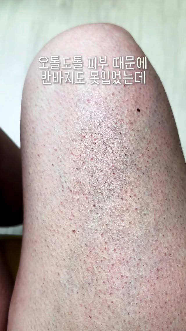 huranna 게시물 이미지: 오톨도톨한 피부 때문에 부끄러워서 반바지도 못입었어요😭

수량 확보 때문에 좀...