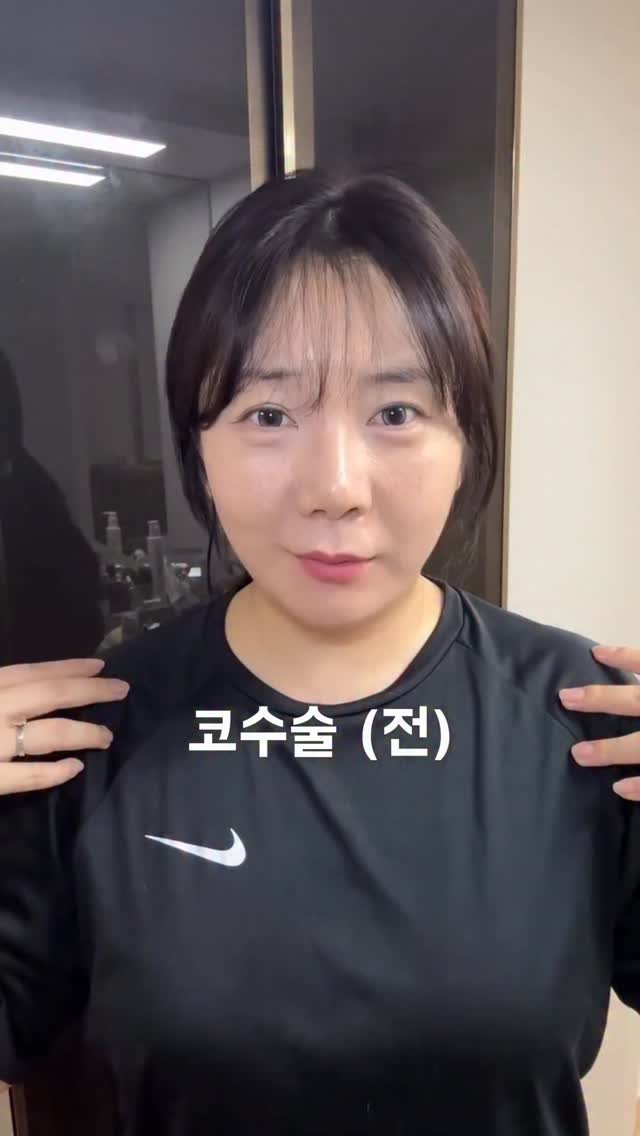 huranna 게시물 이미지: 코수술 7주차까지 변화과정🤔사실 전 내돈내코여서
이렇게까지 노출 의무가 사실...