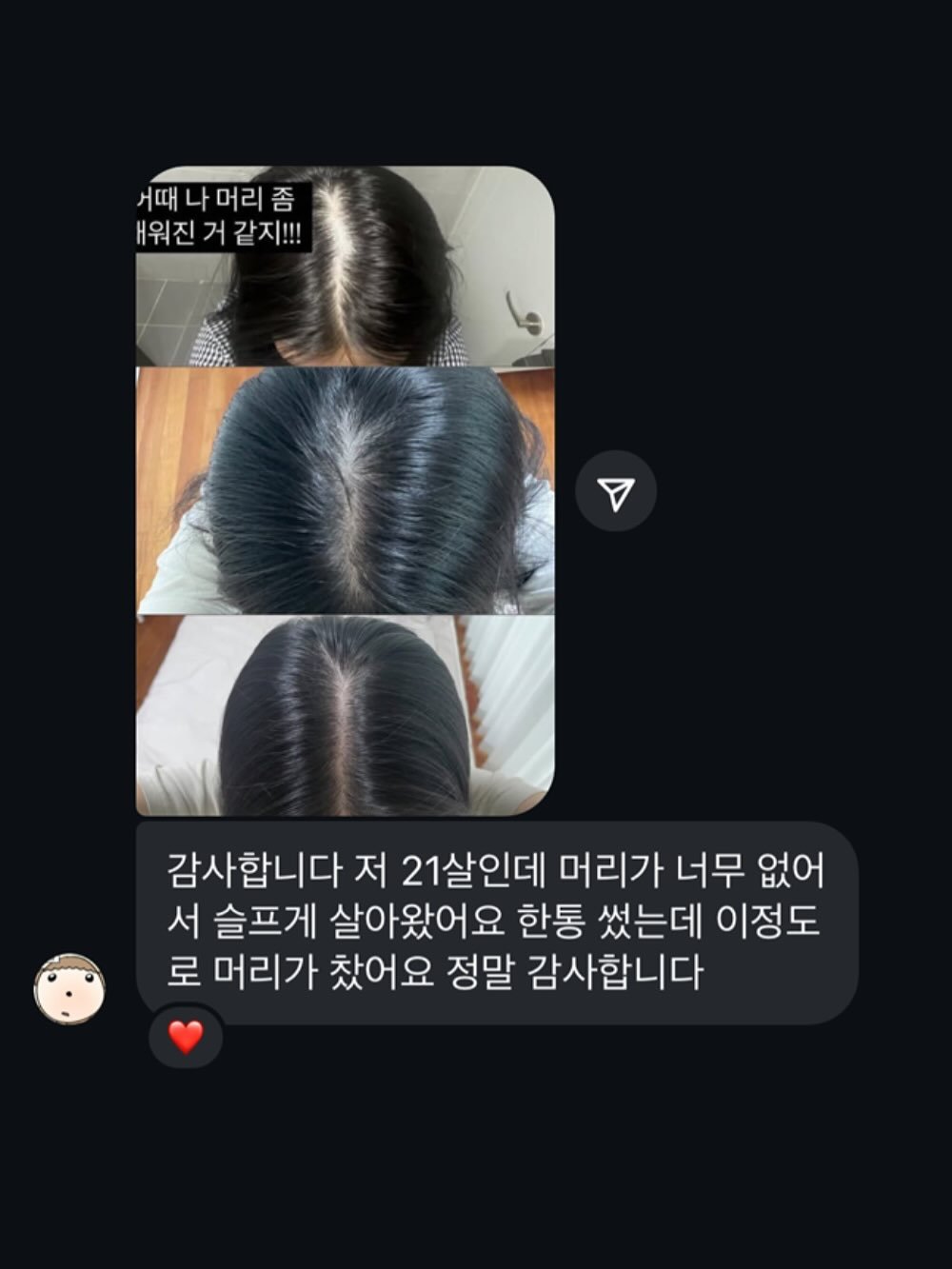 Photo by 이 은경 on August 07, 2025. May be an image of 1 person, long hair and text that says '그때 어때나머리좀 서워진거같지!!! 같지!!! 감사합니다 저 21살인데 머리가 너무 없어 서 슬프게 살아왔어요 한통 썼는데 이정도 로 머리가 찾어요 정말 감사합니다'.