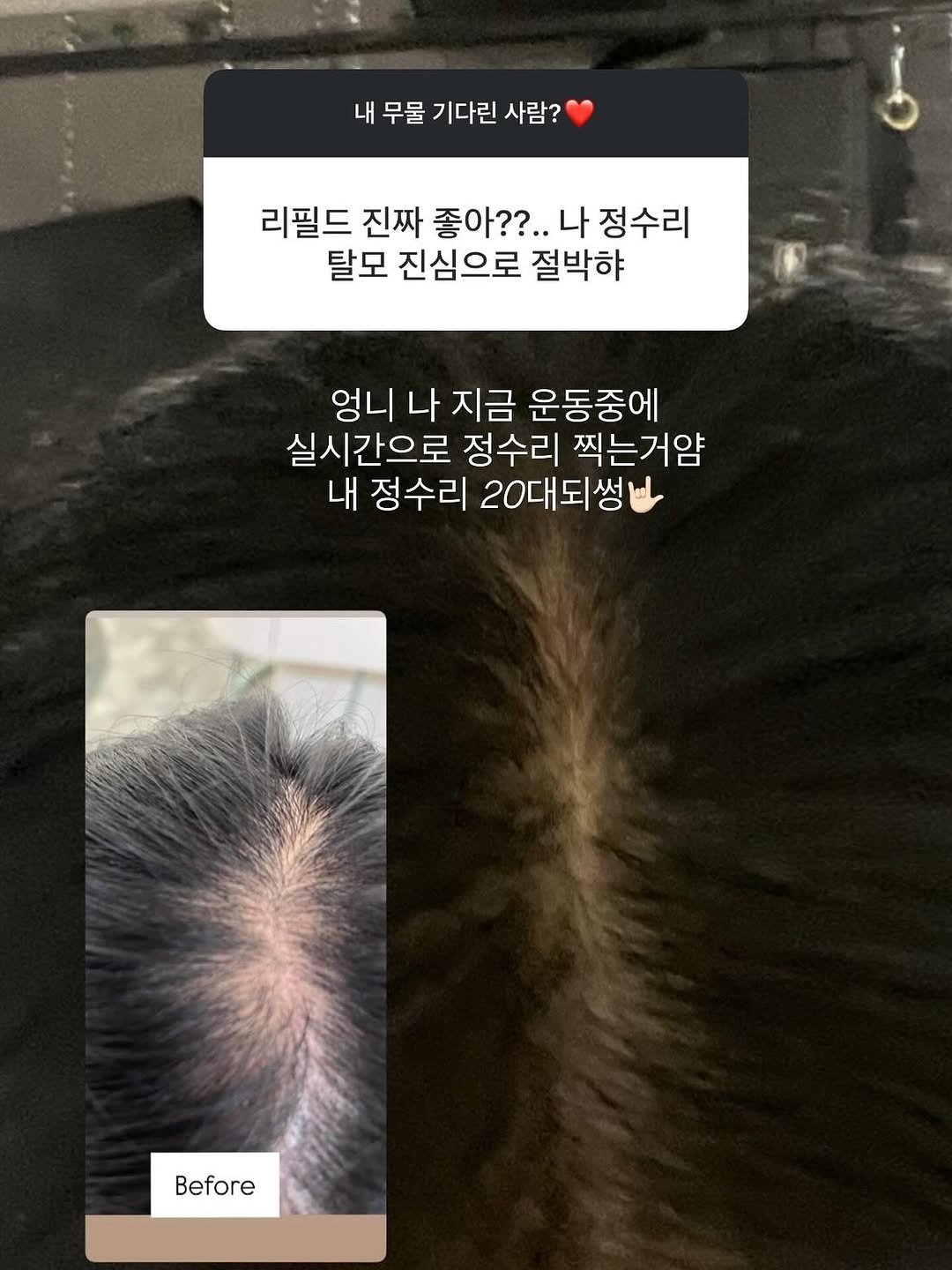 Photo by 이 은경 on August 07, 2025. May be an image of one or more people, hair and text that says '내무물기다린사람? 내 무물 기다린 사람? 리필드 진짜 좋아??..나 ??..나정수리 나 정수리 탈모 진심으로 절박향 엉니 나 지금 운동중에 실시간으로 정수리 찍는거얌 내 내 정수리 20대되썸 Before'.