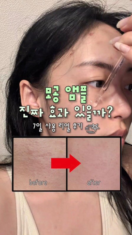 itshaseo 게시물 이미지: 저 진짜 요즘 들어서 모공 때문에 스트레스 엄청 받았거든요…

특히 코 옆...