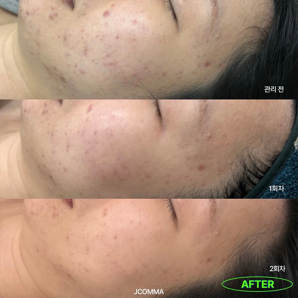 Photo by 제이콤마 대표원장 김주승 🇰🇷 on March 18, 2026. May be an image of text that says '관리전 관리전 1회차 1회차 JCOMMA 2회차 AFTER'.