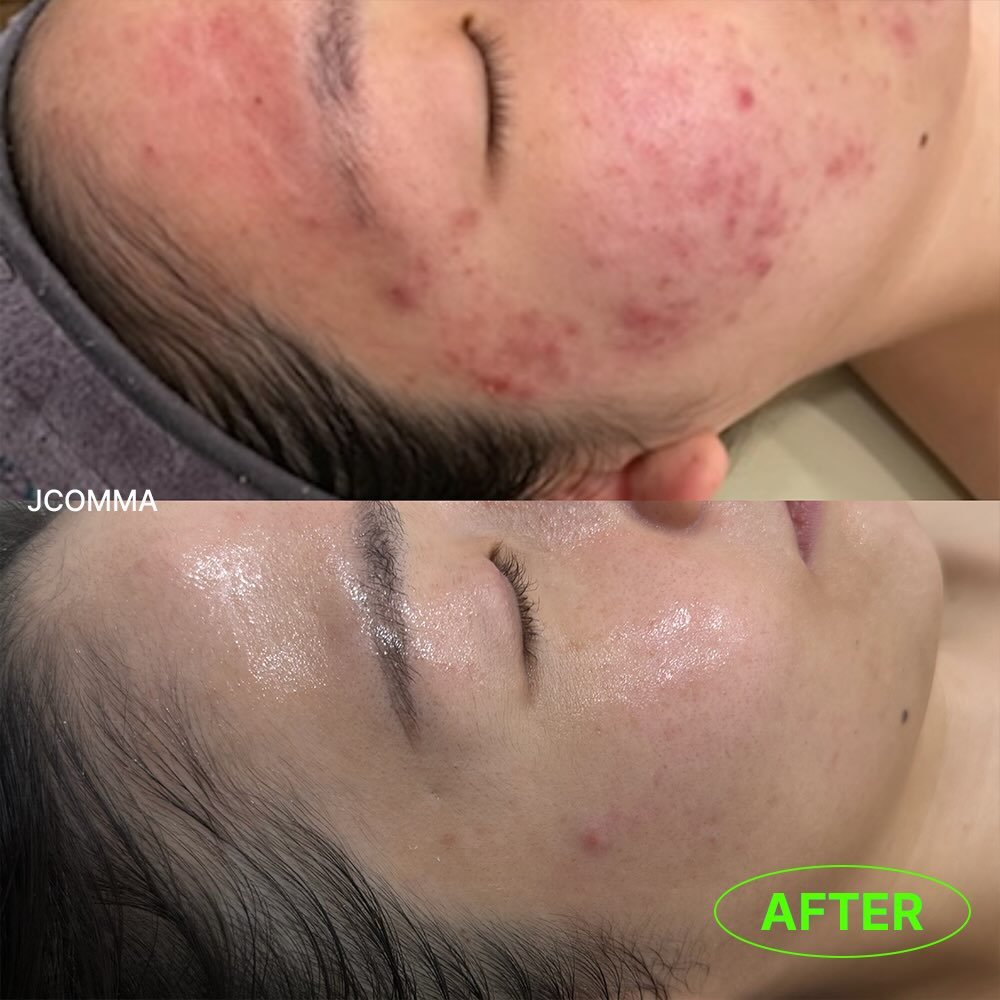 Photo by 제이콤마 대표원장 김주승 🇰🇷 on March 13, 2026. May be an image of text that says 'JCOMMA AFTER'.