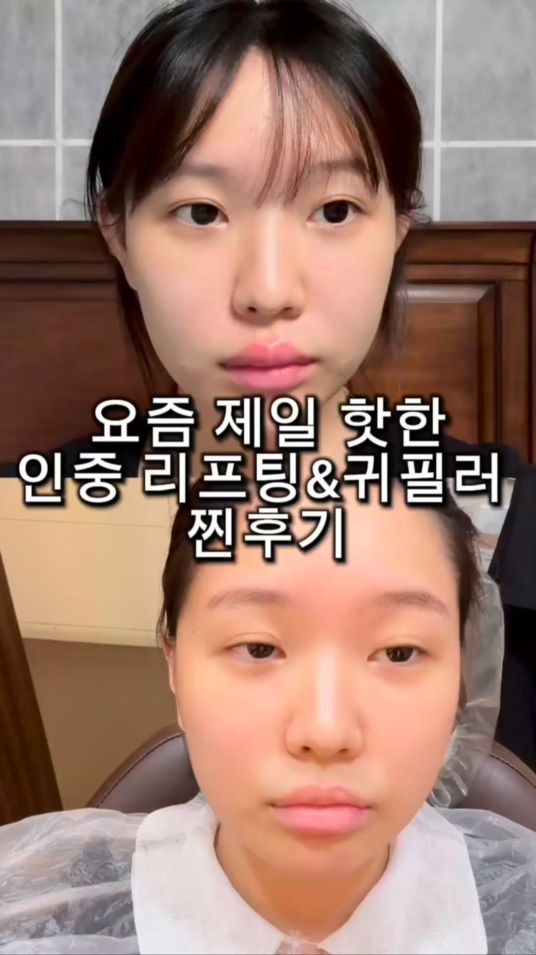 j_ming_dieet 게시물 이미지: 인중 리프팅 & 귀필러 비포애프터 

정보 원하시는분들은 댓글에 “정보” 해주시면...