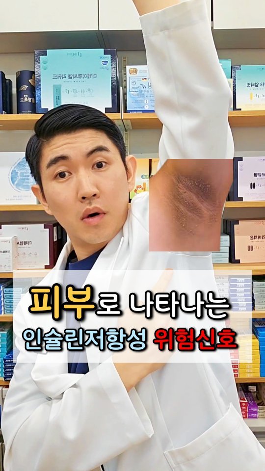 jasin_yaksa 게시물 이미지: ⬇️⬇️⬇️ 피부로 먼저 나타나는 인슐린 저항성 신호들👇👇

✅️ 인슐린 저항성이...