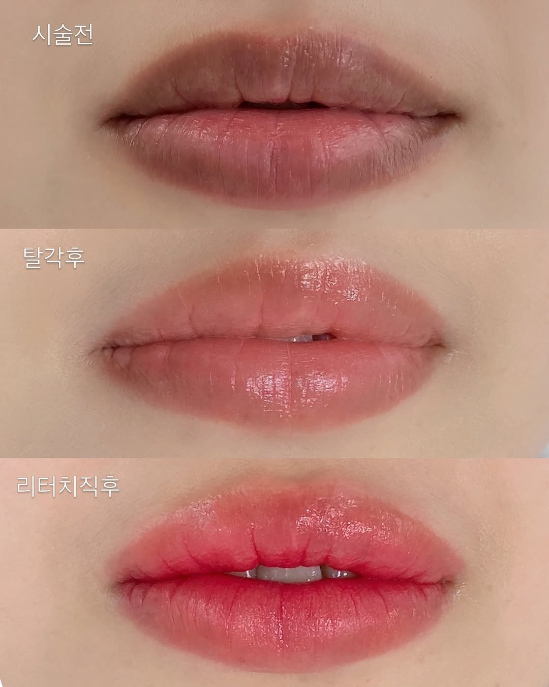 jerry_ppeum 게시물 이미지: 제리쁨_립컬러체인지 🫧

저번에 올렸던 어두운 입술 중화 탈각후예요!
1차 작업...