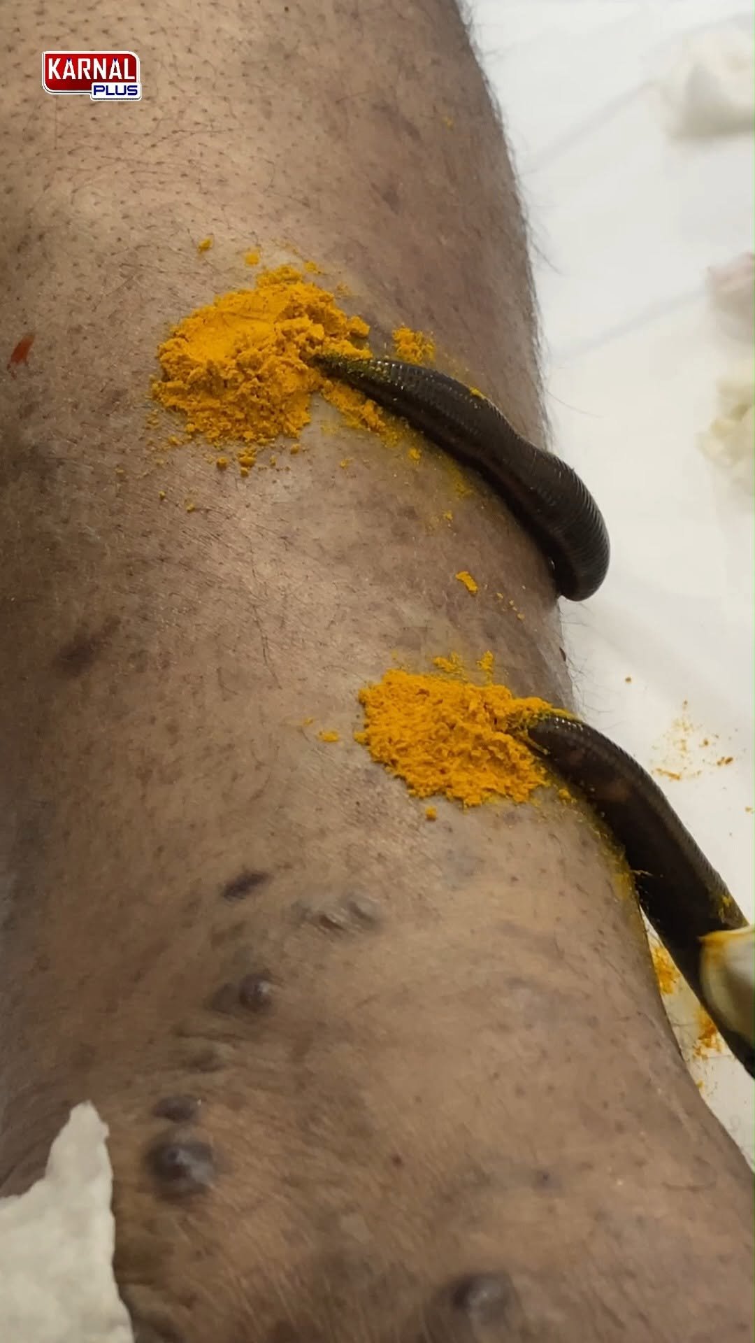 karnalplus 게시물 이미지: 🐛पैरों में लगा ये छोटा जीव हुआ चमत्कारिक फायदा...