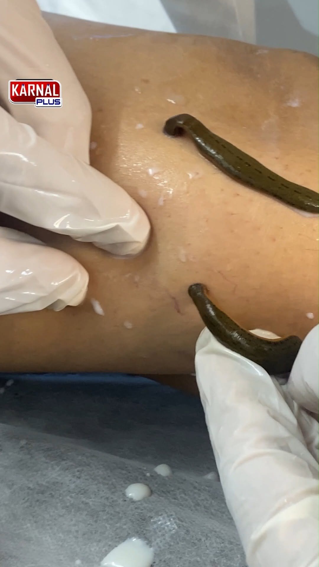 karnalplus 게시물 이미지: 2 साल से घुटनो में दर्द था इस जलोका ने कैसे...