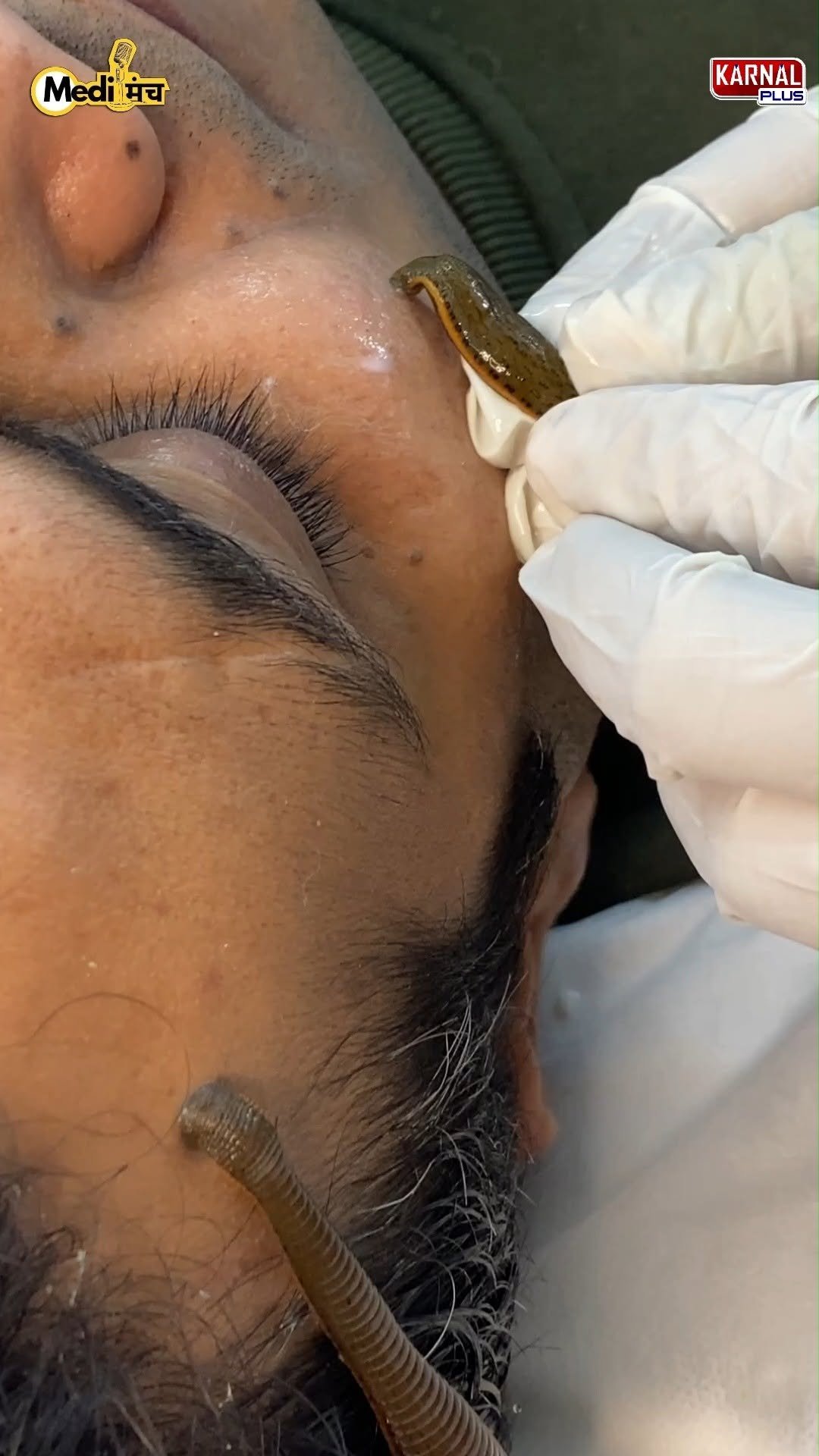 karnalplus 게시물 이미지: गंजेपन और चेहरे के पिंपल झाइयों में ये जोक...
