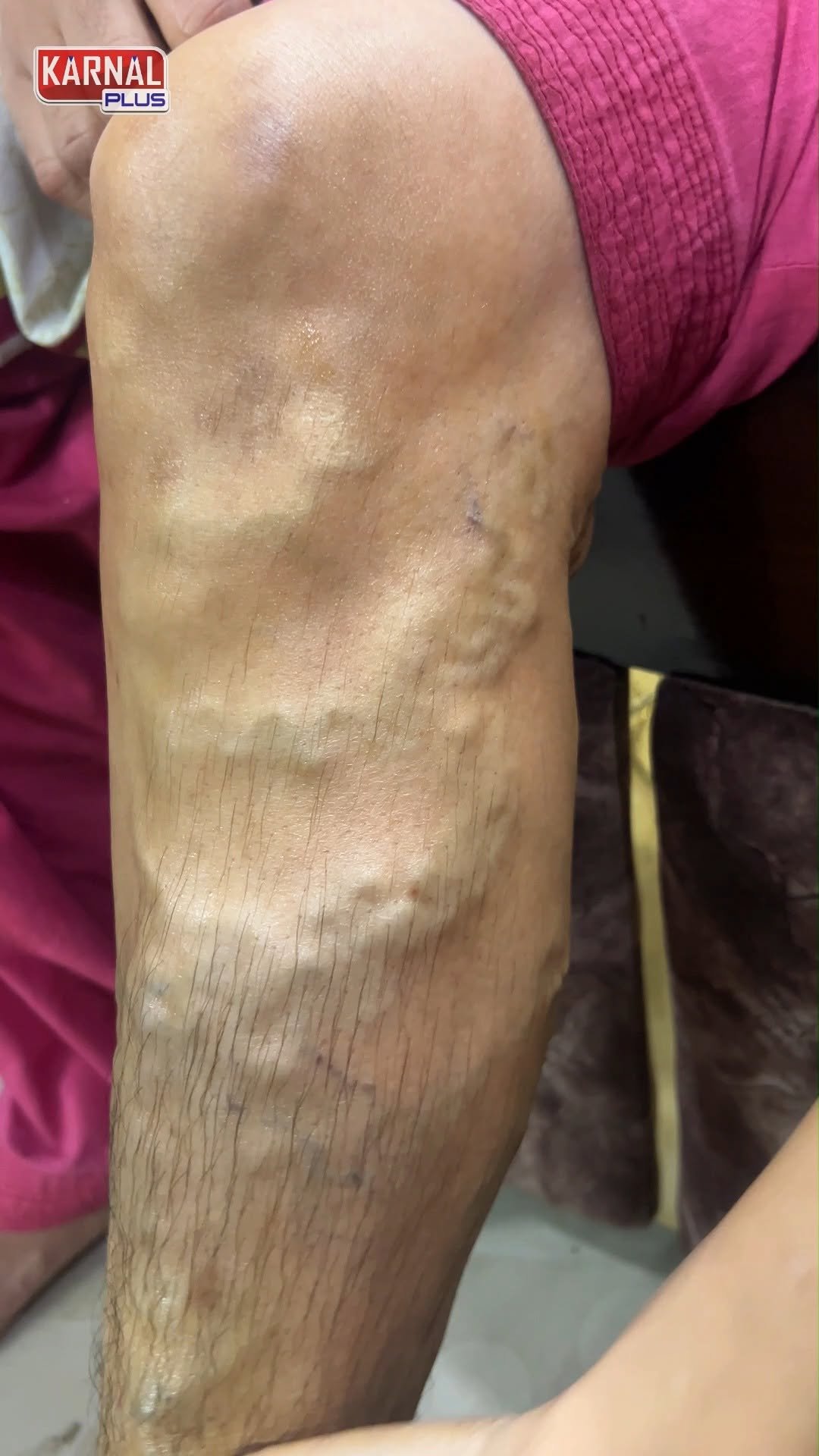 karnalplus 게시물 이미지: नसों की ब्लॉकेज और गांठ दोनों गायब ⚡#viralvídeo #insta