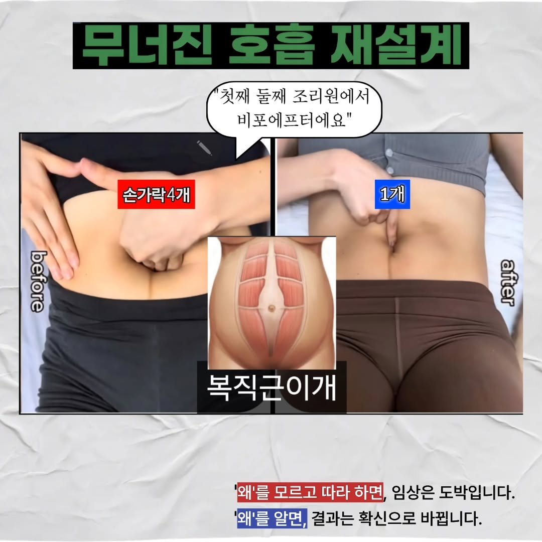 keiden1980 게시물 이미지: [​[복직근이개와 가짜 날숨의 진실]

.

👶 "첫째 때와 둘째 때의 복직근이개...