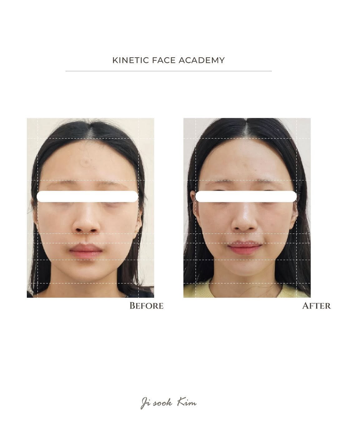 kinetic_aesthe_cheongdam 게시물 이미지: 