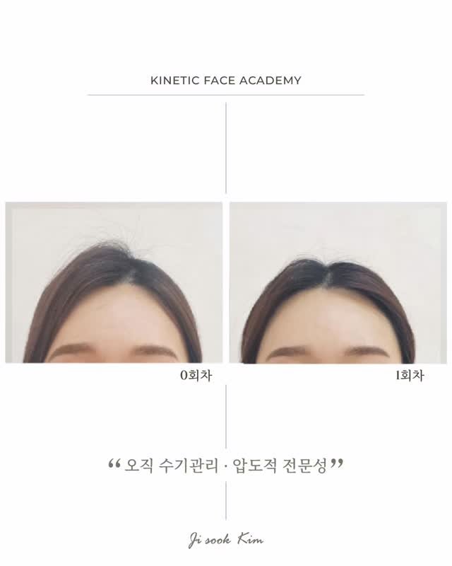 kinetic_aesthe_cheongdam 게시물 이미지: 키네틱 테크닉의 제일 첫번째변화.

'이마' 입니다.

늘 학생선생님들, 그리고...