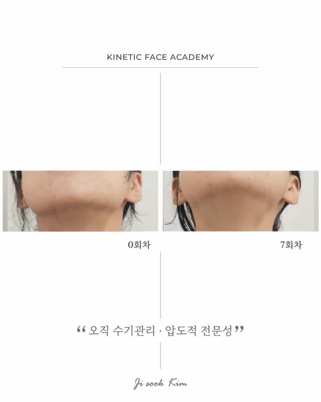 kinetic_aesthe_cheongdam 게시물 이미지: 페이스관리법에는 다양함이 있죠!

그 중에서 제가 제일 으뜸이다! 가...