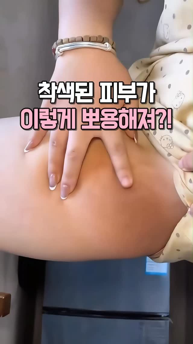 kkooltem_kkoolsaeng 게시물 이미지: 사타구니 착색 때문에 수영복은 꿈도 못 꿨거든요 
피부과에서 일하는 친구가
이...