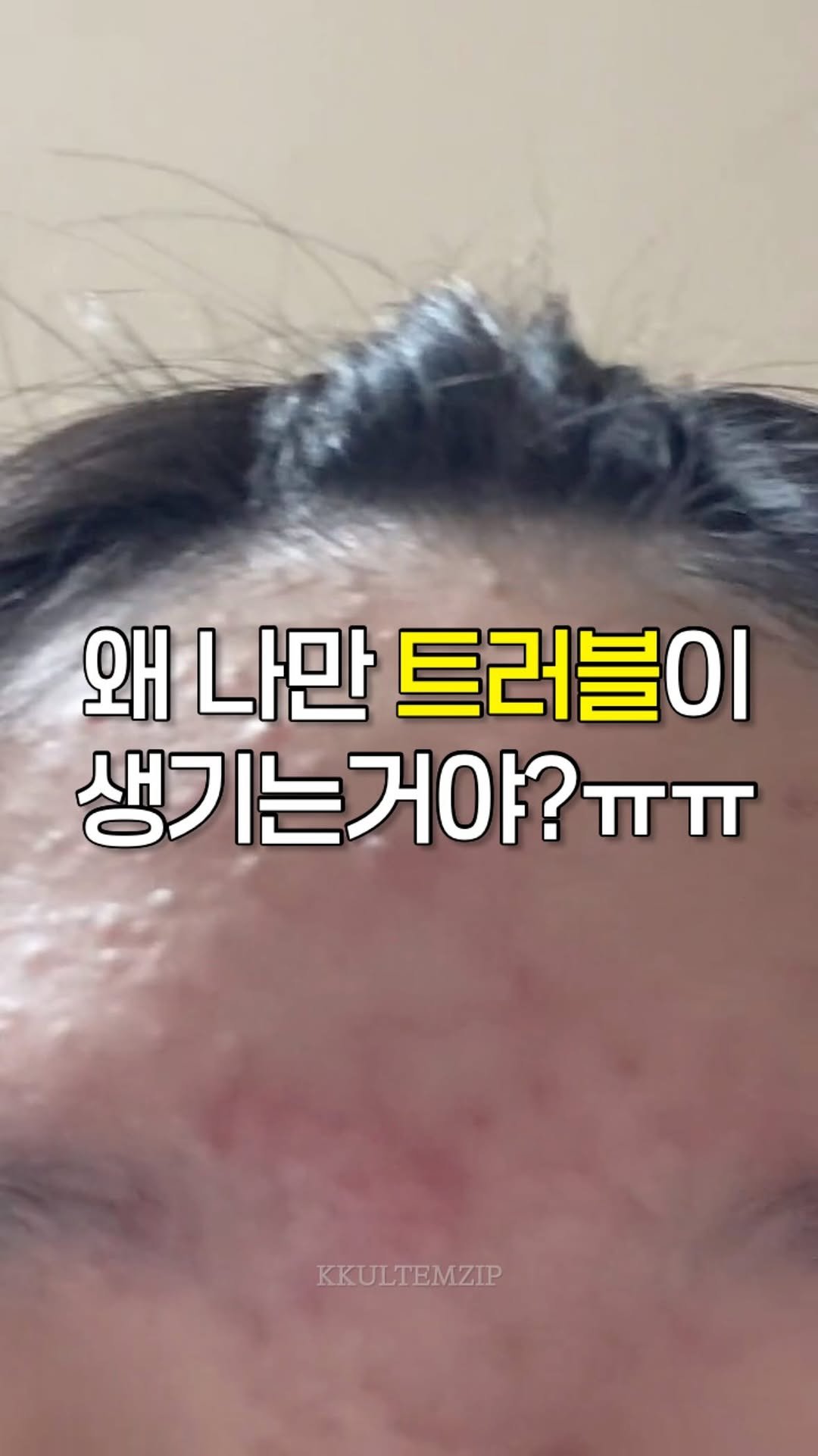 kkul_tem_zip 게시물 이미지: 피부과 전문의가 추천함 앰플 궁금하시면 댓글에 ‘진정‘ 남겨주세요💌

트러블 자주...