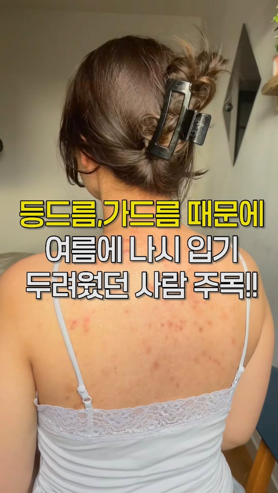 kkul_tem_zip 게시물 이미지: 등드름, 가드름 이제 탈출해봐요😡
댓글에 ‘❤️’ 남겨주세요💌

✔️ 영유아도...
