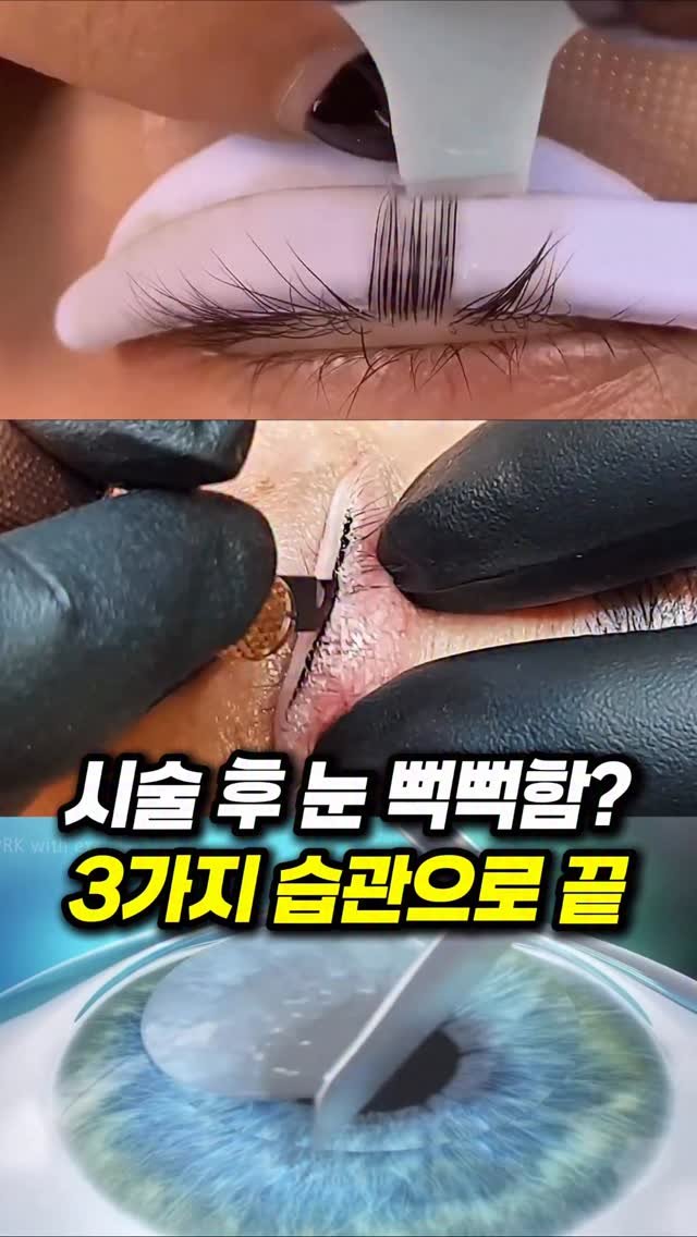 kmom_yaksa 게시물 이미지: 시술 후 눈 더 건조해진 분들
인공눈물만 넣는다고 해결 안 됩니다
마이봄선 염증까지...
