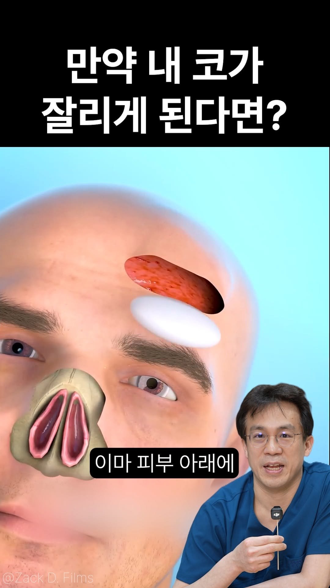 ko_losseum 게시물 이미지: 이마에 코를 만든다고❓

✅사고로 코가 괴사되거나 잘린 경우 이마에 코를 만드는...
