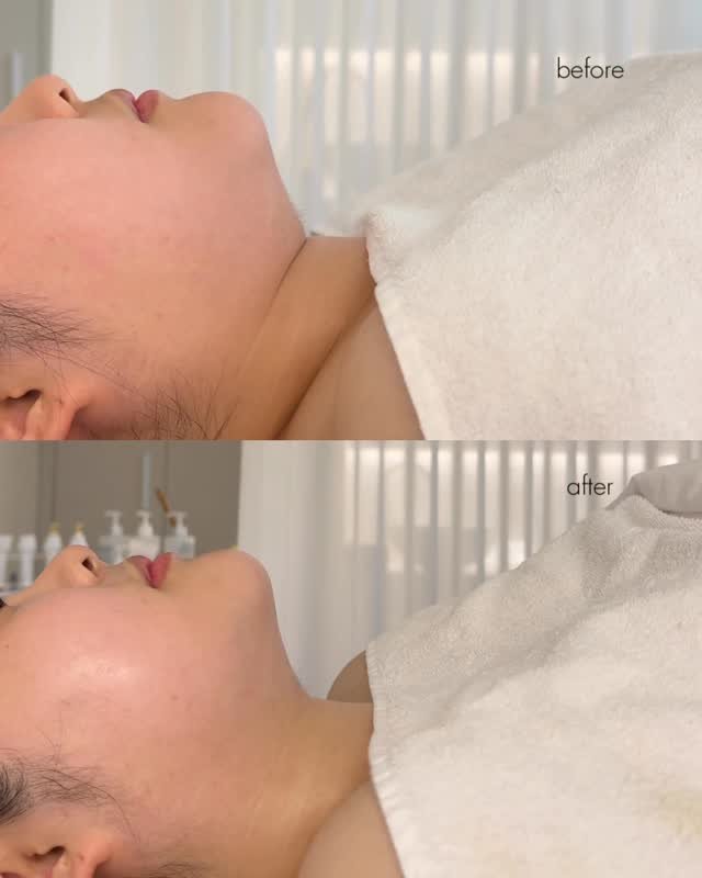 lediv_aesthetic 게시물 이미지: 티리온X + 유소르
1회 직후 턱선 돌아오는 르디브 꿀조합✨

1회만 받아도 변화가...