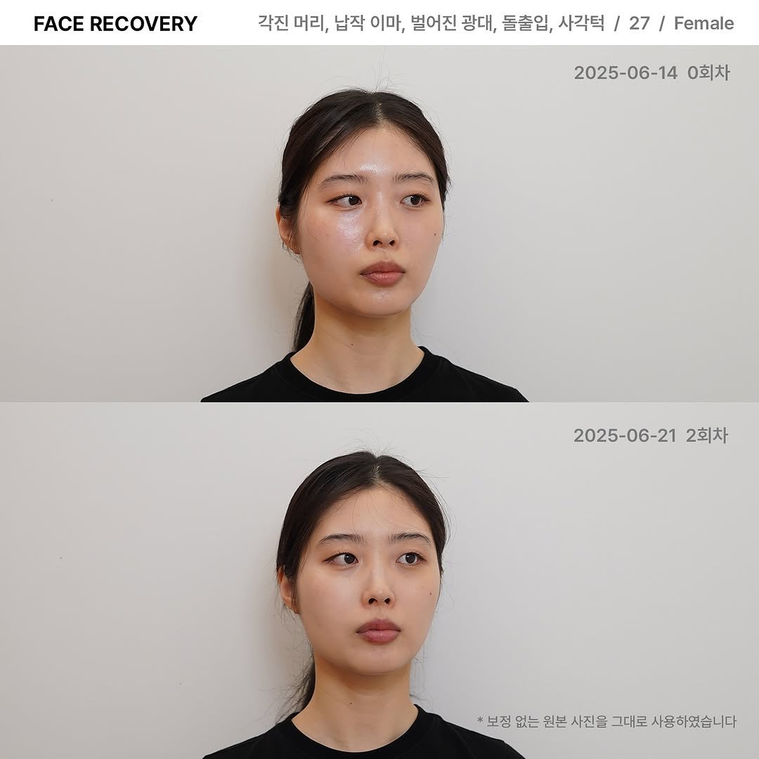 lesouffle.beaute 게시물 이미지: ⠀
⠀
광대의 형태를 변화시키기 위해서는
광대만 다룬다고 해결되지...