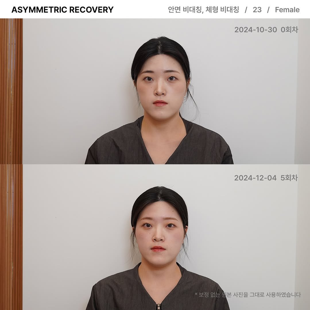 lesouffle.beaute 게시물 이미지: ⠀
⠀
비대칭 리커버리 프로그램은
사진 촬영 및 방송, 면접시 보여지는 얼굴...