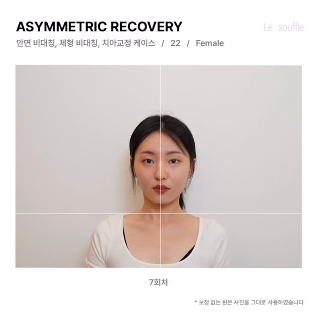 lesouffle.beaute 게시물 이미지: ⠀
⠀
비대칭이 있는 상태에서 치아교정을 하는 경우,
치아 이동으로 상하악이...