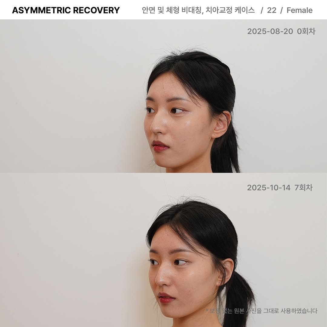 lesouffle.beaute 게시물 이미지: ⠀
⠀
척추 구조가 무너지면
이마가 눕고, 입과 턱이 밀려나오며,
중하안이 무겁고...